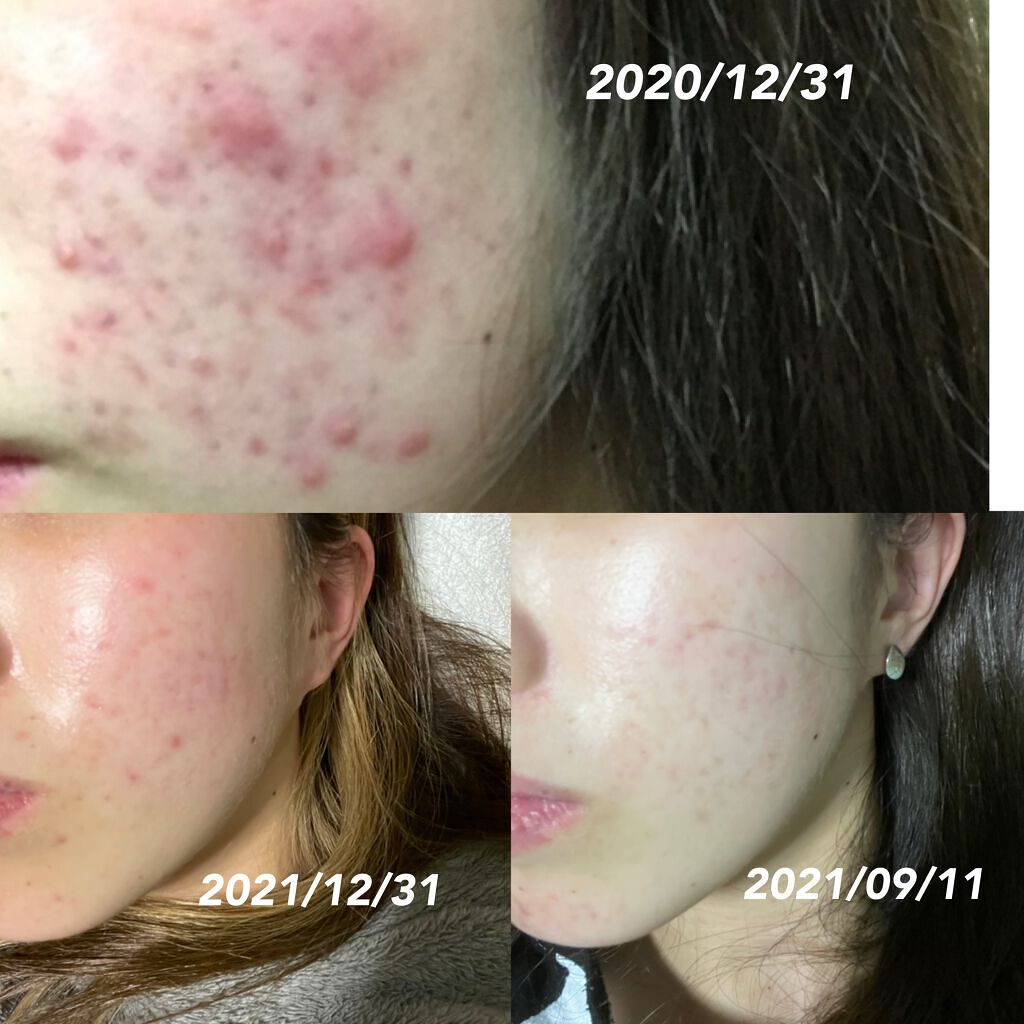 イハダ 薬用バーム【医薬部外品】/IHADA/フェイスバームを使ったクチコミ(3枚目)