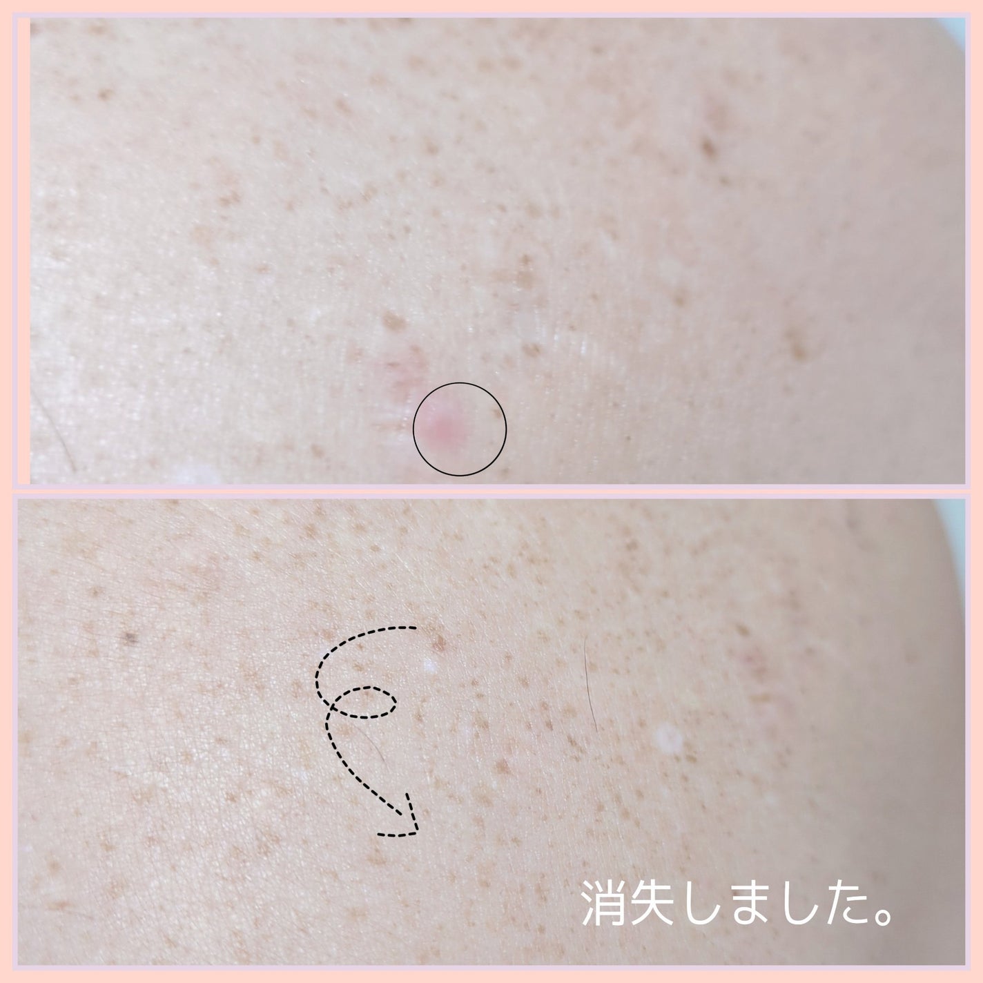 レッドアクネ ボディピーリングショット/MEDICUBE/ピーリングを使ったクチコミ(8枚目)