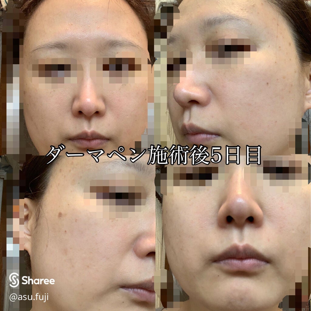 asu.fuji on LIPS 「ダーマペンのダウンタイムの続きです。前回の投稿は、2日目までし..」(4枚目)