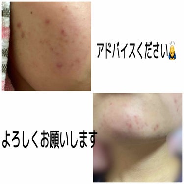 もちこ on LIPS 「いきなり初投稿で汚肌&悩み相談になってしまい申し訳ないです😢私..」（2枚目）