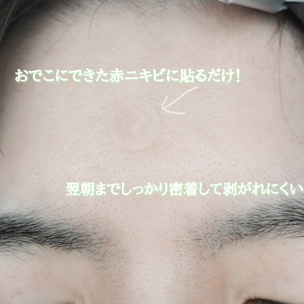 プロCICA クリアスポットパッチ/VT/その他スキンケアを使ったクチコミ(6枚目)