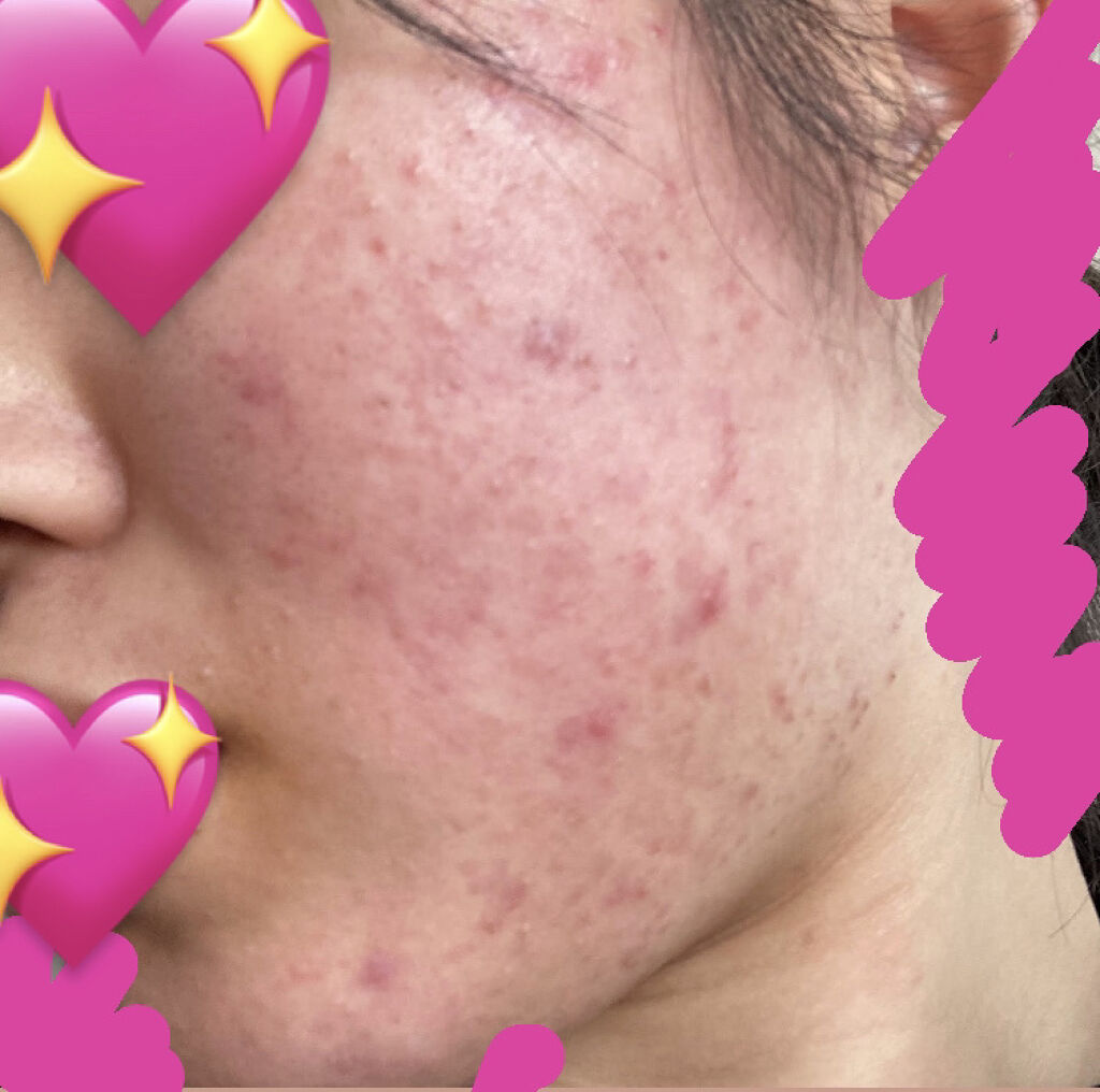 ハトムギ化粧水(ナチュリエ スキンコンディショナー R )/ナチュリエ/化粧水を使ったクチコミ（2枚目）