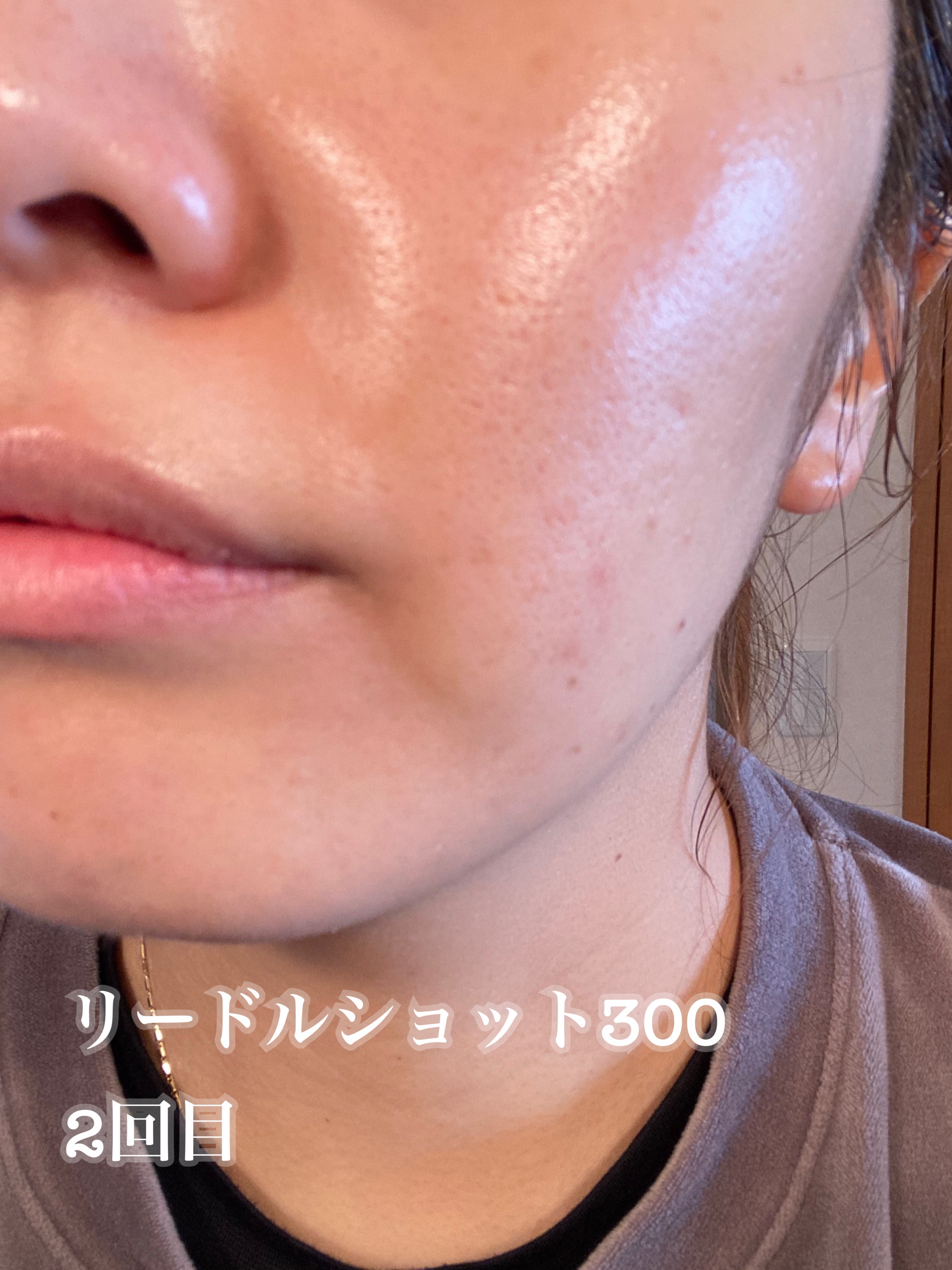 リードルショット300/VT/美容液を使ったクチコミ（3枚目）