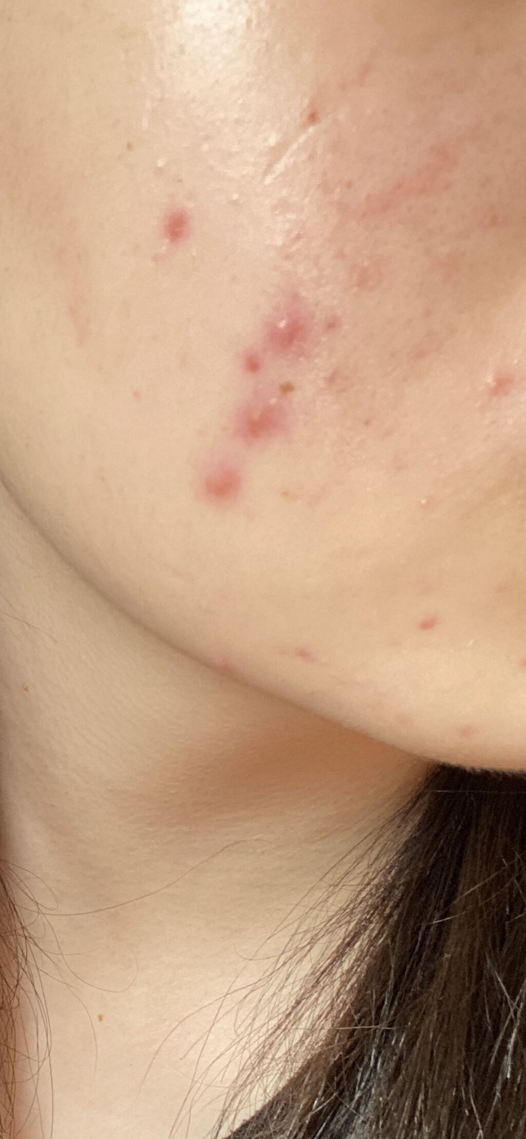 ヒルマイルドクリーム(医薬品)/健栄製薬/その他を使ったクチコミ（1枚目）