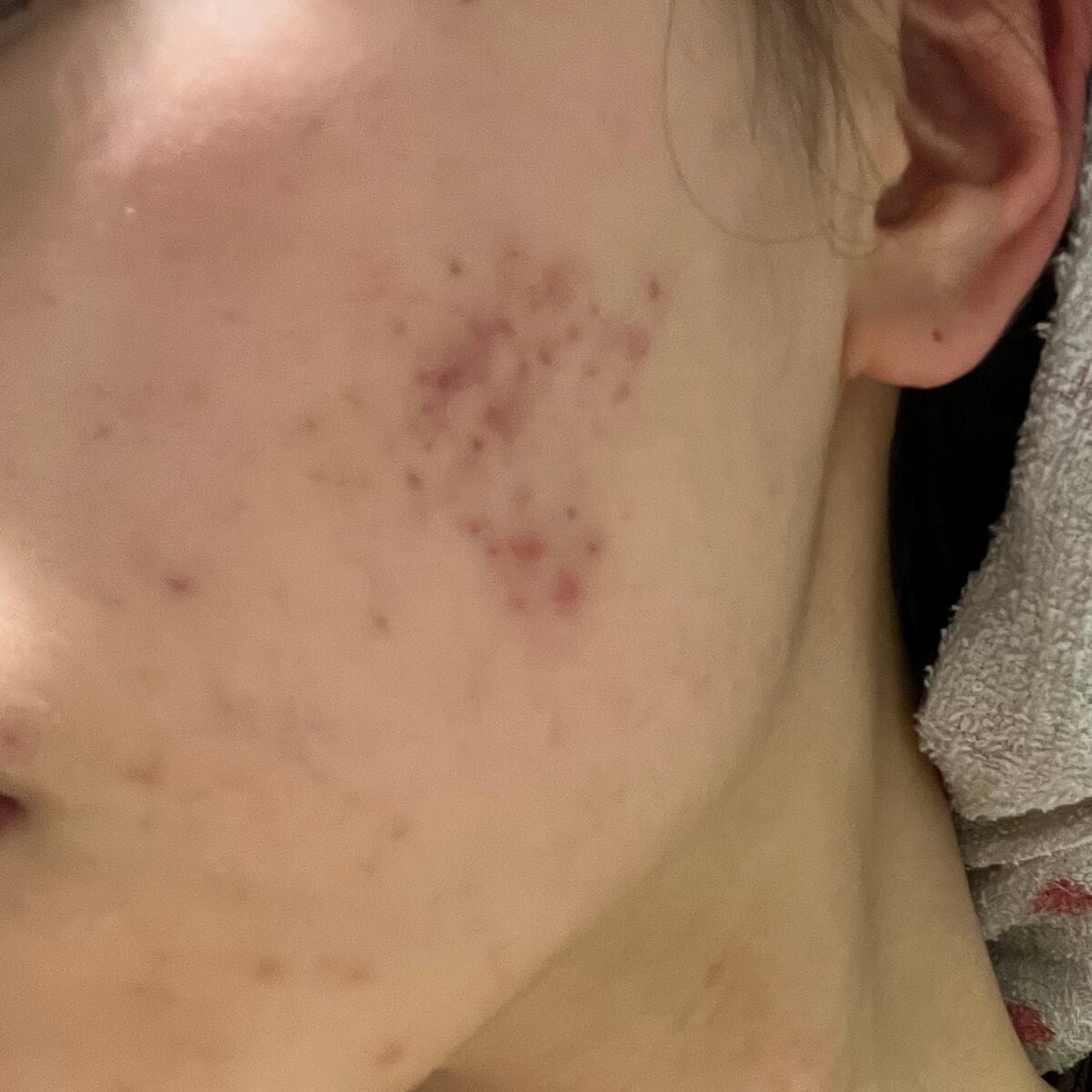 ののの on LIPS 「《ニキビ治療日記》もともと、私はニキビはそこまでいっぱいできる..」(1枚目)