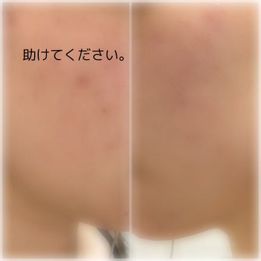 クラブ すっぴんナチュラルクリアジェルのクチコミ「アドバイスやみなさんのスキンケアなど教えて頂けたら幸いです。

両頬のニキビ跡や毛穴の黒ずみが.....」（1枚目）