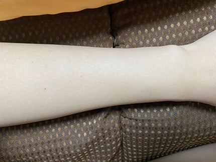 アイスレディ/icelady/家庭用脱毛器を使ったクチコミ(7枚目)