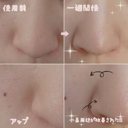 チョコブラ スペシャル毛穴ケアセット/Chocobra/スキンケアキットを使ったクチコミ(3枚目)