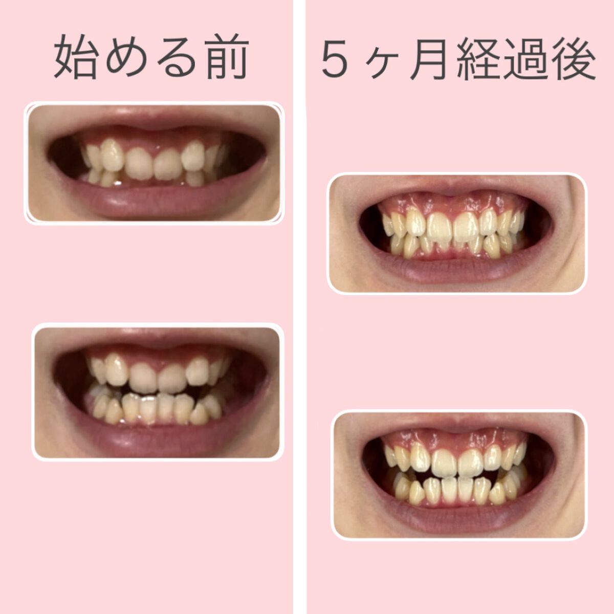 糸ようじ/小林製薬/デンタルフロス・歯間ブラシを使ったクチコミ（2枚目）