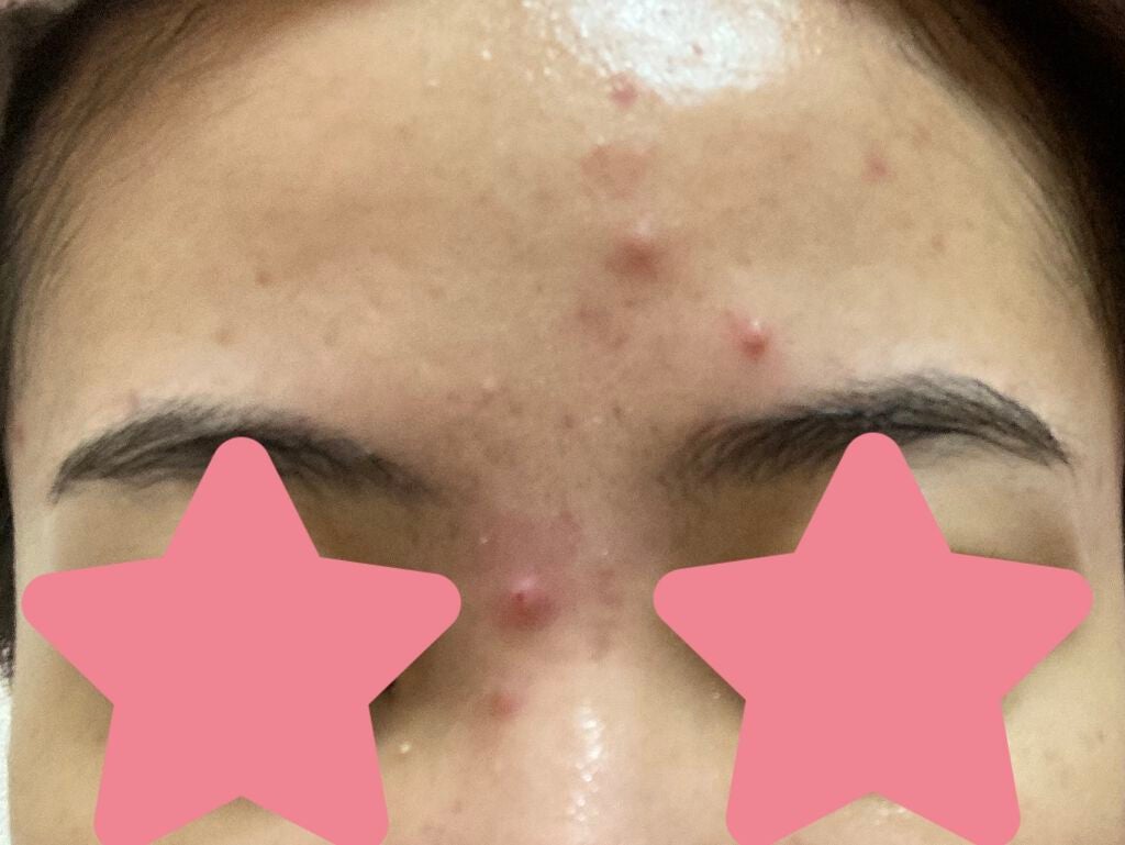 ૮ . ̫ . ა on LIPS 「この肌荒れをどうにかしたい(2021/09/0901:32:1..」(1枚目)