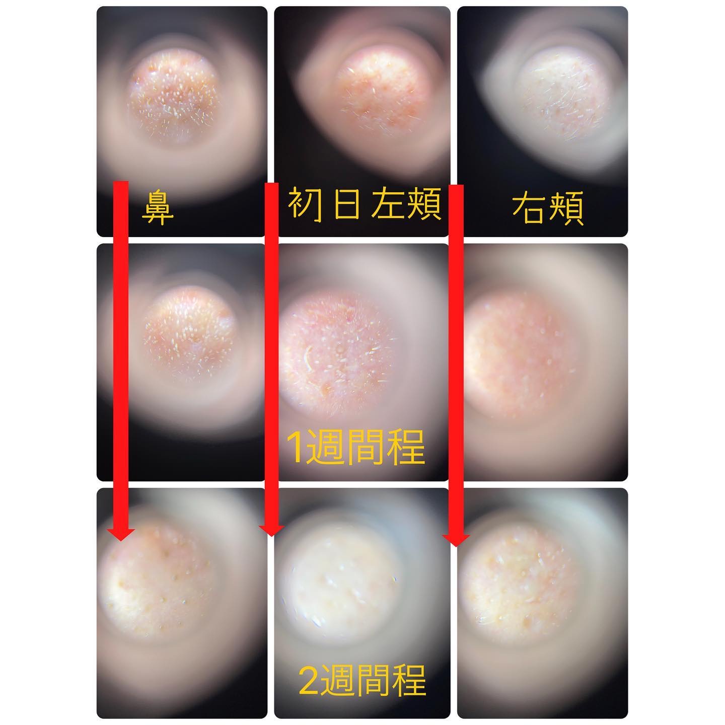リードルショット300/VT/美容液を使ったクチコミ（3枚目）