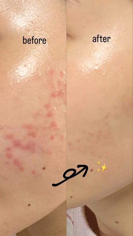 薬用しみ集中対策 プレミアム美容液/メラノCC/美容液を使ったクチコミ(1枚目)