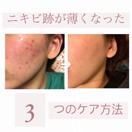 VC-20 ビタミンC誘導体/TUNEMAKERS/美容液を使ったクチコミ(1枚目)