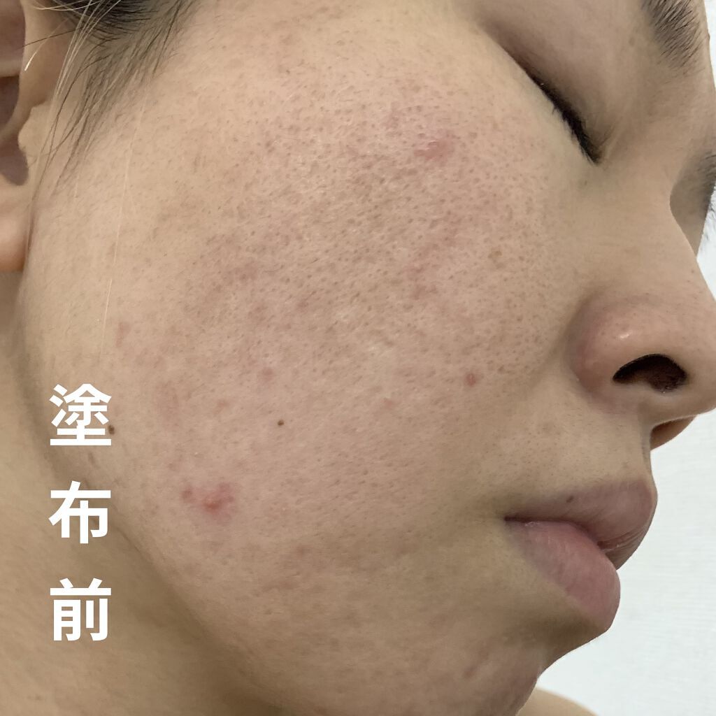 マジックティーツリーオイル/ブラン/フェイスオイルを使ったクチコミ（2枚目）