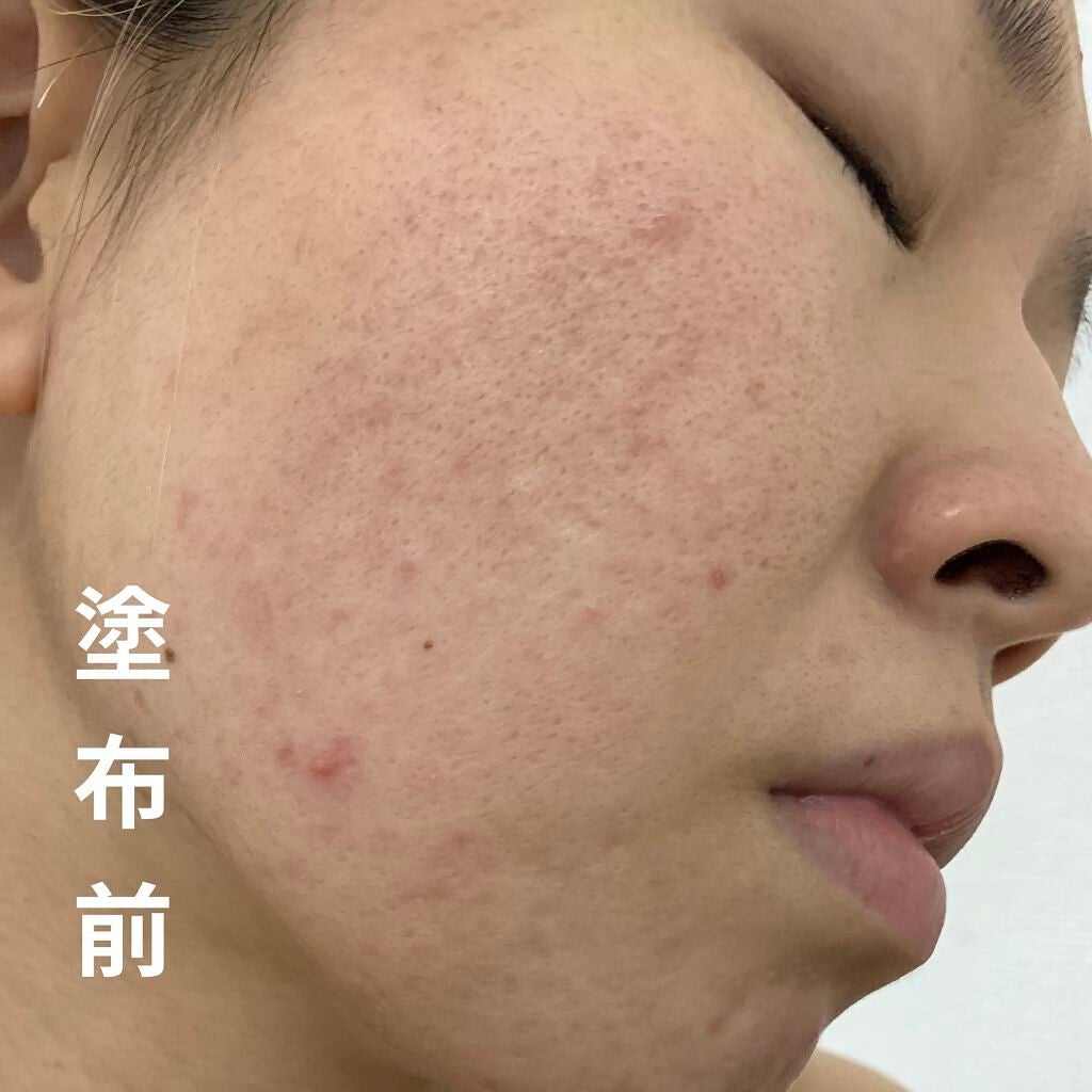 マジックティーツリーオイル/ブラン/フェイスオイルを使ったクチコミ(2枚目)