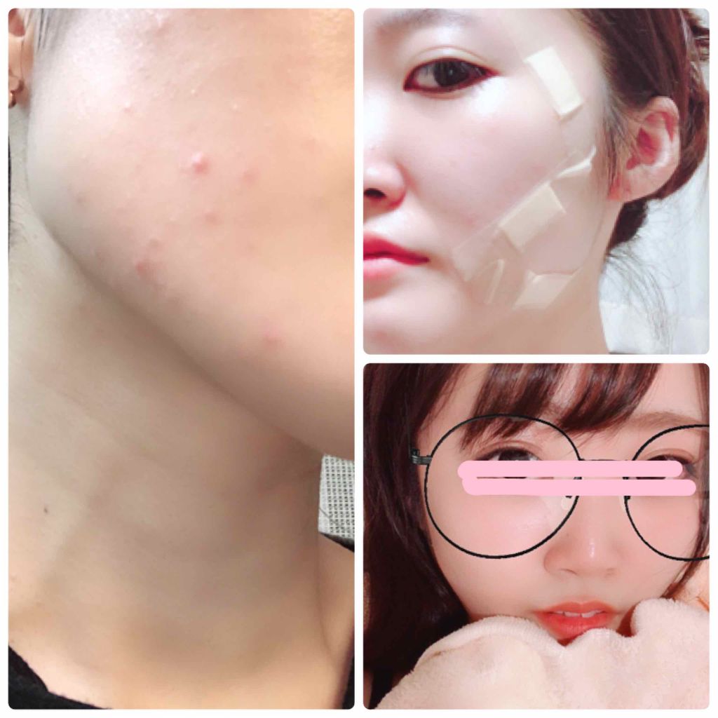 ペアアクネクリームW(医薬品)/ペア/その他を使ったクチコミ（2枚目）