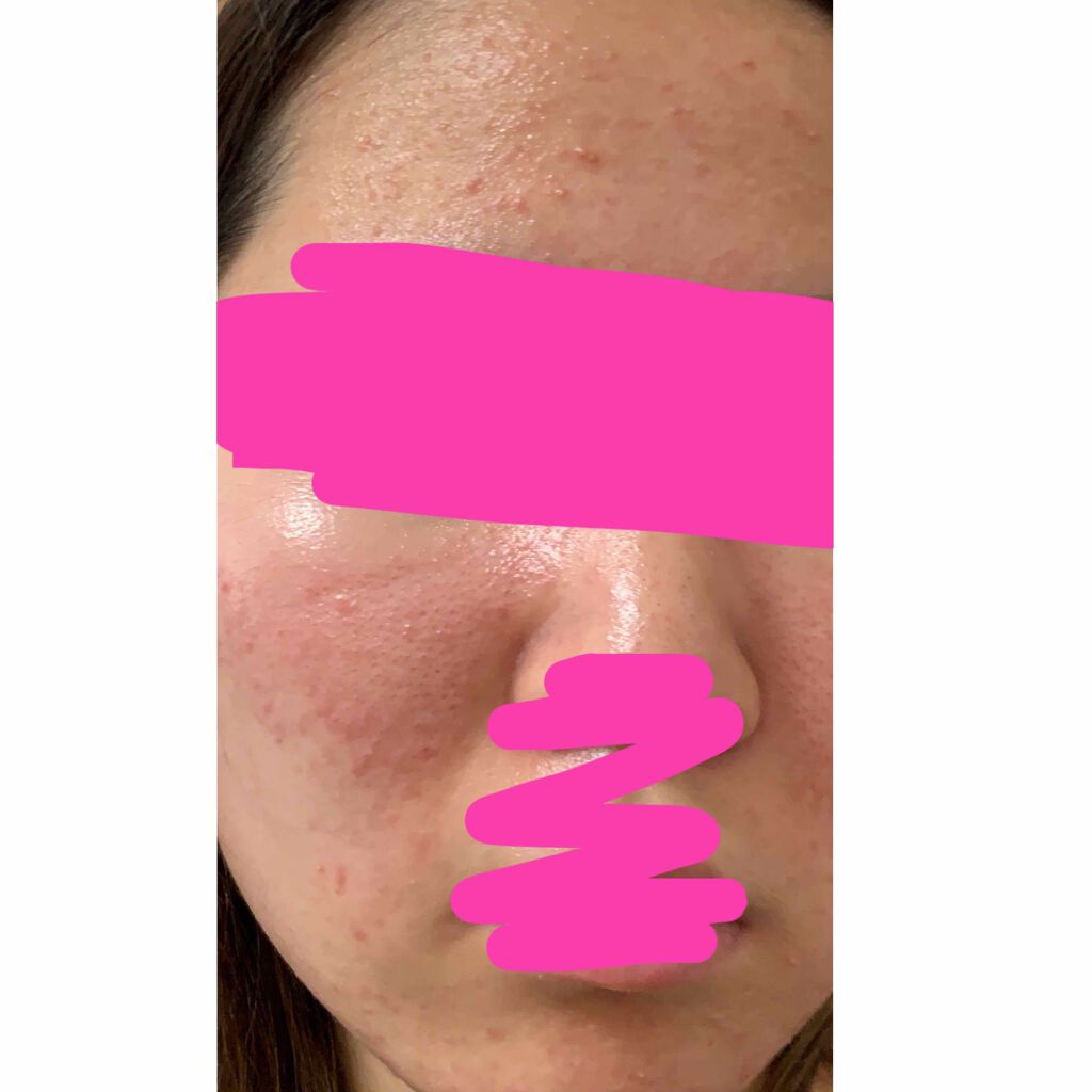 十味敗毒湯(医薬品)/ツムラ/その他を使ったクチコミ(2枚目)