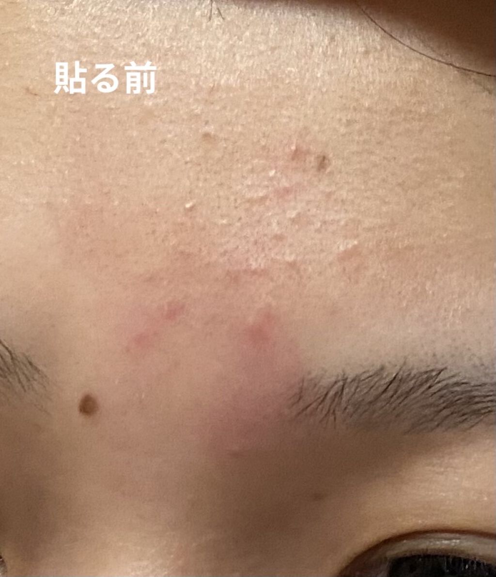 プロCICA クリアスポットパッチ/VT/その他スキンケアを使ったクチコミ（2枚目）