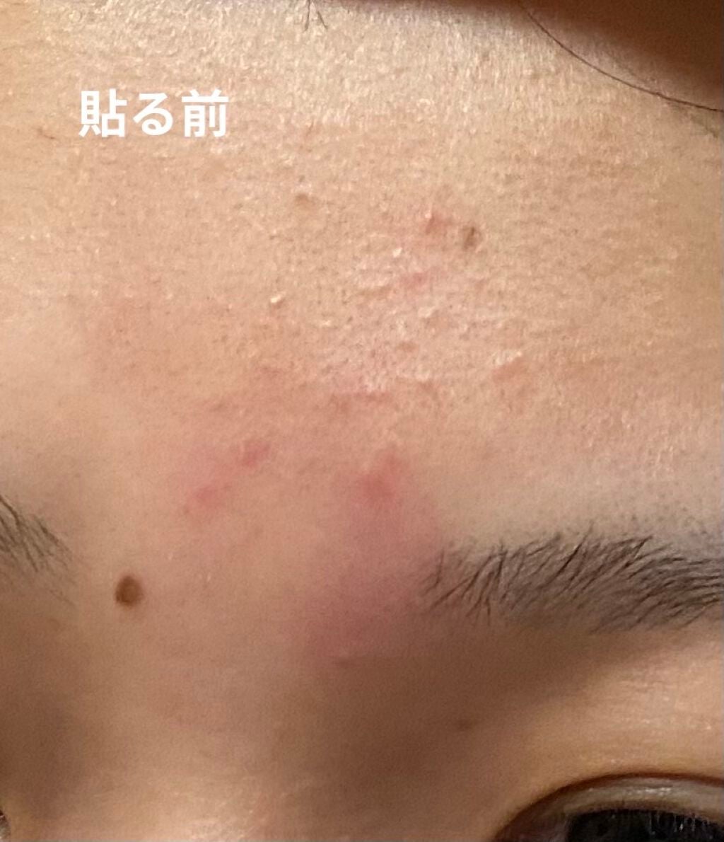 プロCICA クリアスポットパッチ/VT/その他スキンケアを使ったクチコミ(2枚目)