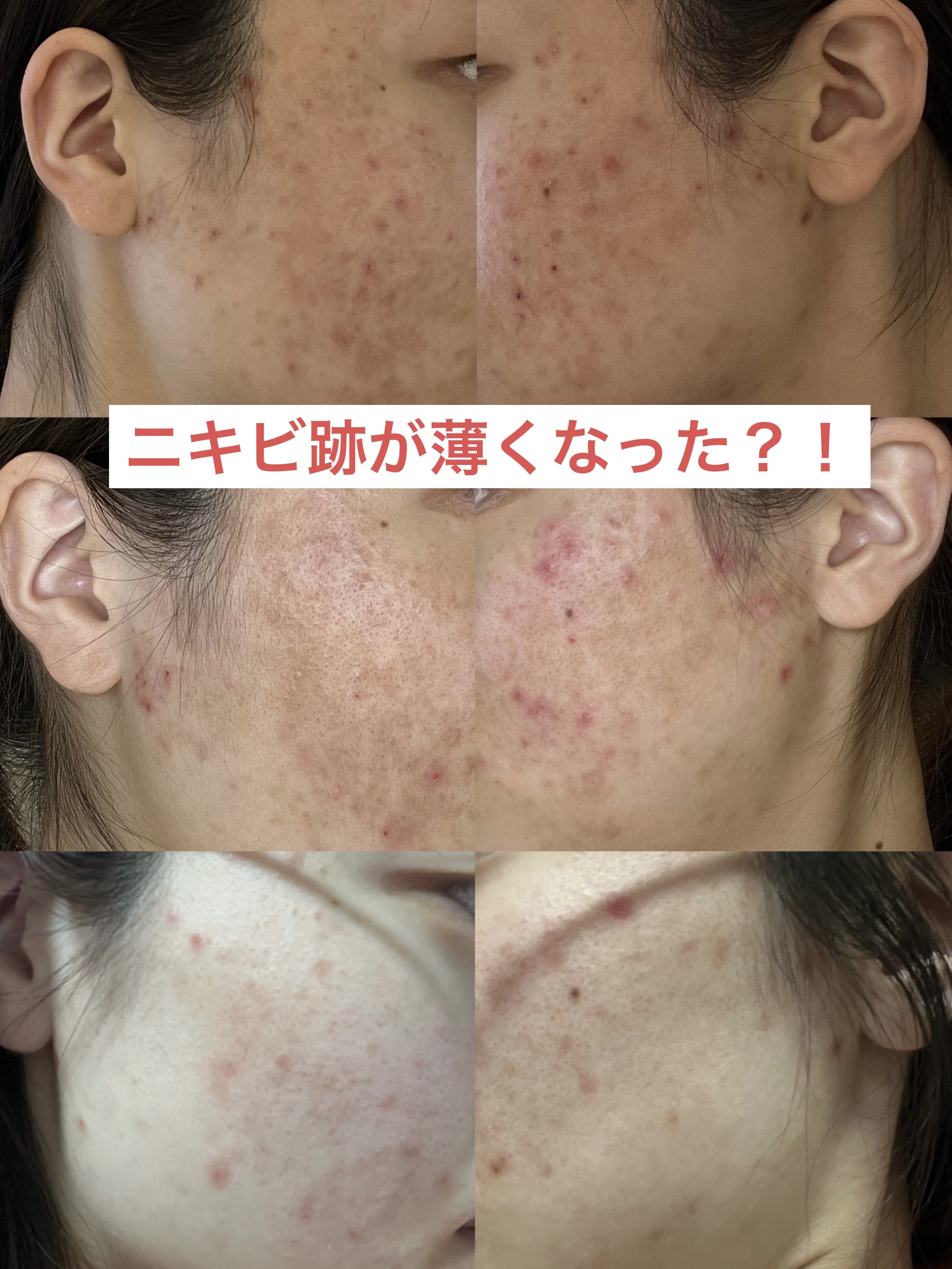 潤浸保湿 化粧水 III とてもしっとり/キュレル/化粧水を使ったクチコミ（1枚目）