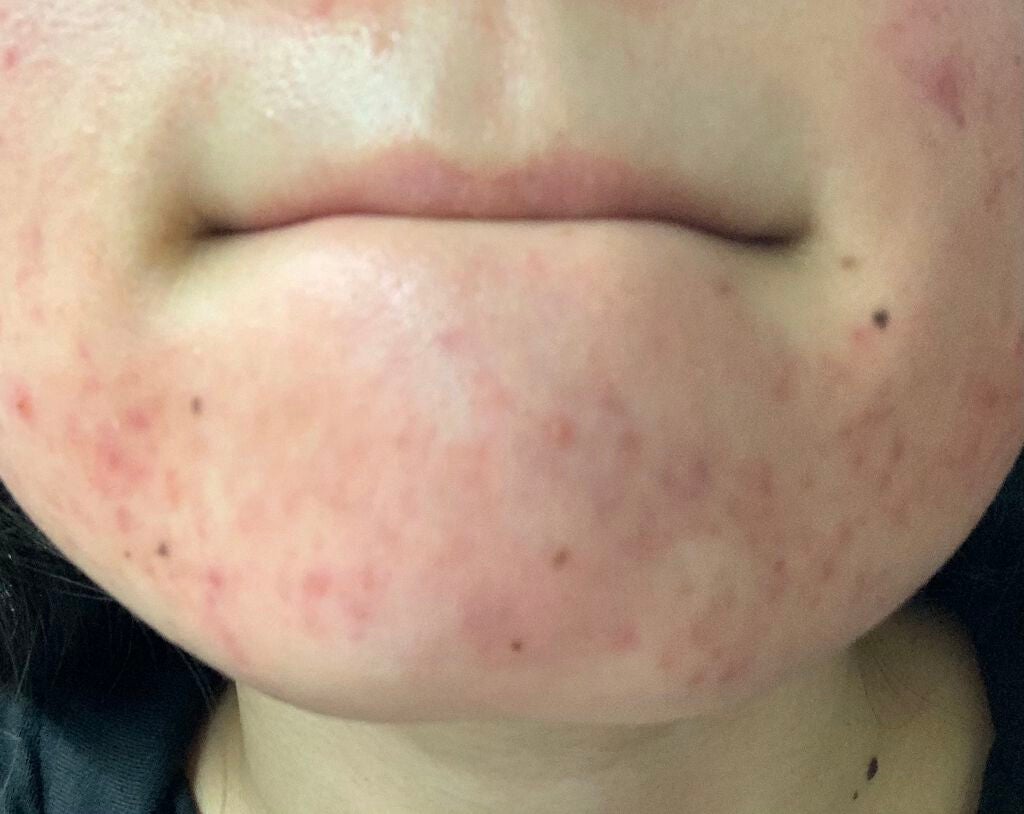 ちい on LIPS 「【私のニキビ日記】⚠️ニキビ肌の写真があります!苦手な方はご注..」(4枚目)