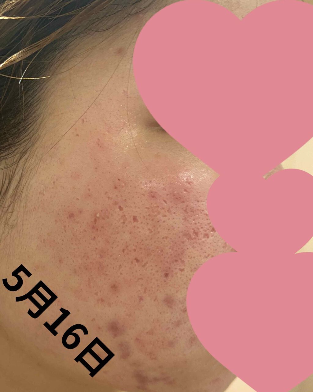 ! on LIPS 「皮膚科処方薬5日目見た目はそんなに変わらないですが、肌触りがツ..」(2枚目)