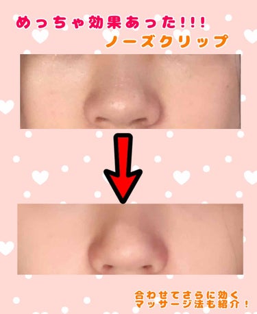 まか on LIPS 「【マジか‪...‬！】ノーズクリップ本当に効果あるすげぇ‼️こ..」（1枚目）