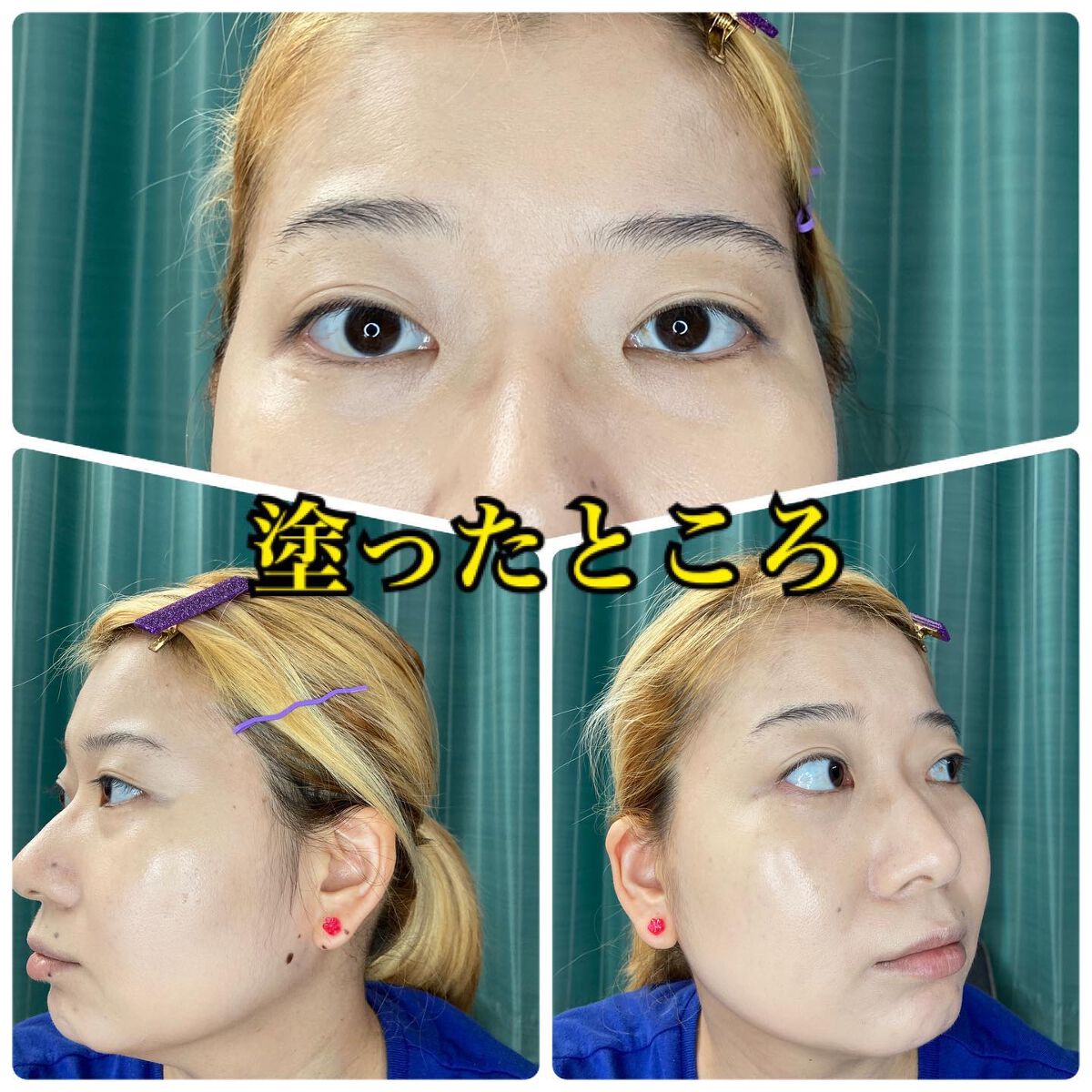 薬用クリアエステヴェール/Macchia Label/リキッドファンデーションを使ったクチコミ(9枚目)