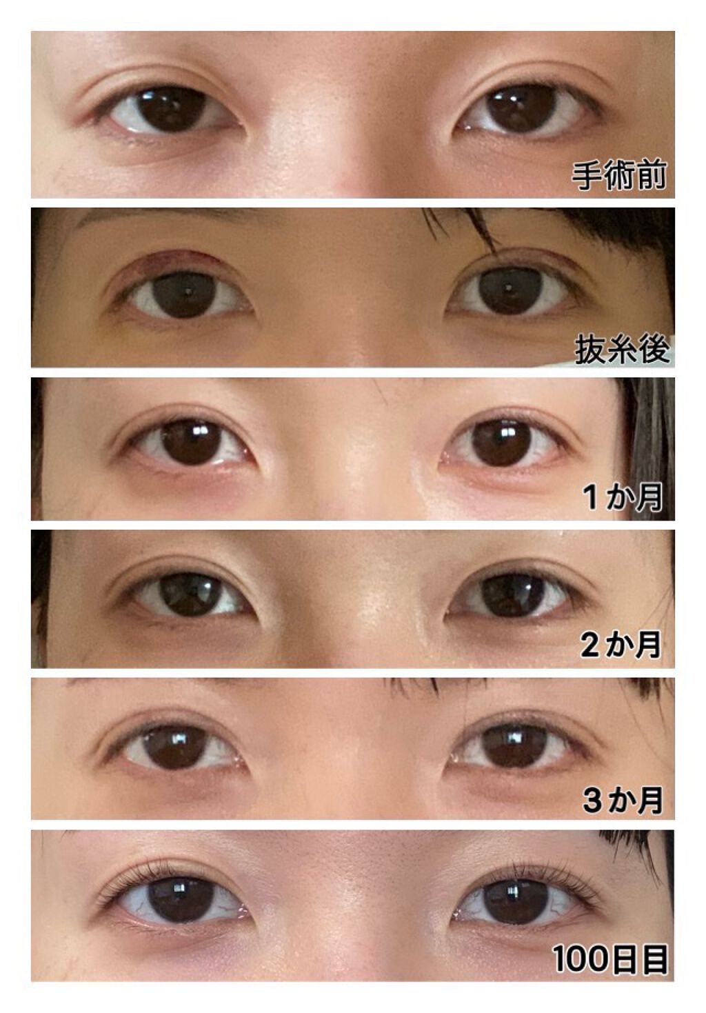 二重整形/その他を使ったクチコミ（2枚目）