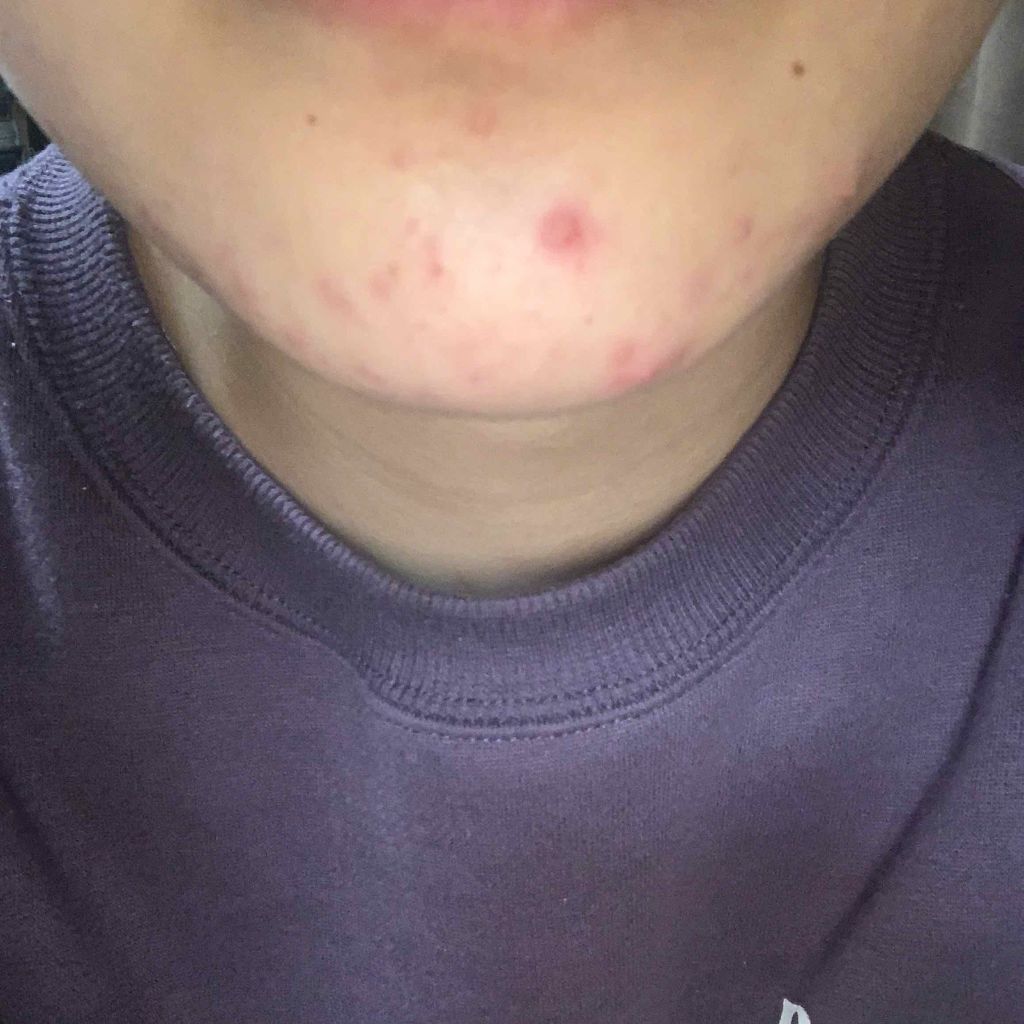 sparkle_lips_i2z6 on LIPS 「ほんとに助けてください…18歳の高3ですニキビがずっと出来て困..」(4枚目)