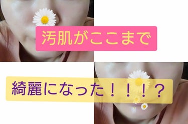 なつ♡ on LIPS 「まだたまにニキビができるときもありますがここまでましになりまし..」（1枚目）