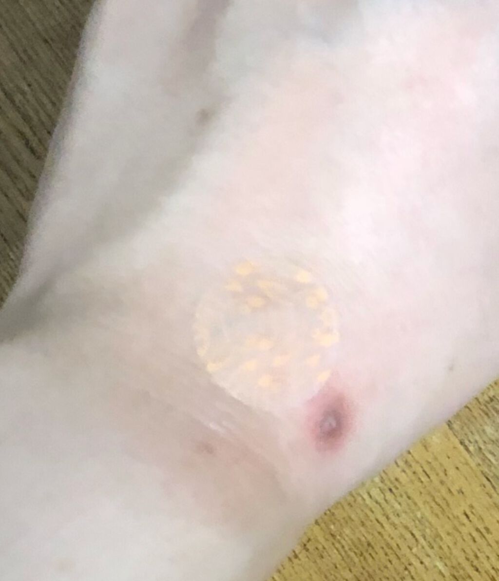 マキロンかゆみどめパッチp 医薬品 マキロンを使った口コミ ムヒパッチa マキロンかゆみどめパッチp By 愛上御ﾛｶ Lips