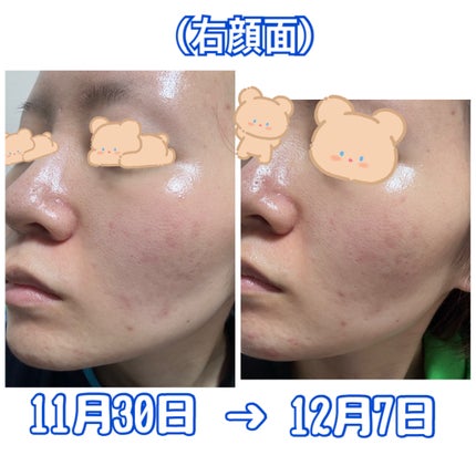 白潤 薬用美白化粧水(しっとりタイプ)/肌ラボ/化粧水を使ったクチコミ(4枚目)