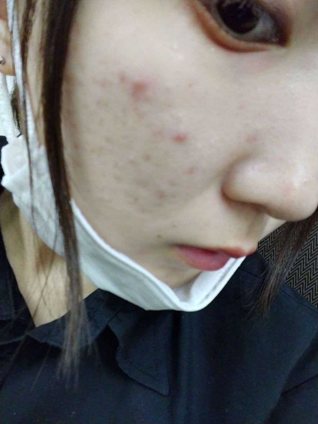 ペアアクネクリームW(医薬品)/ペア/その他を使ったクチコミ（2枚目）