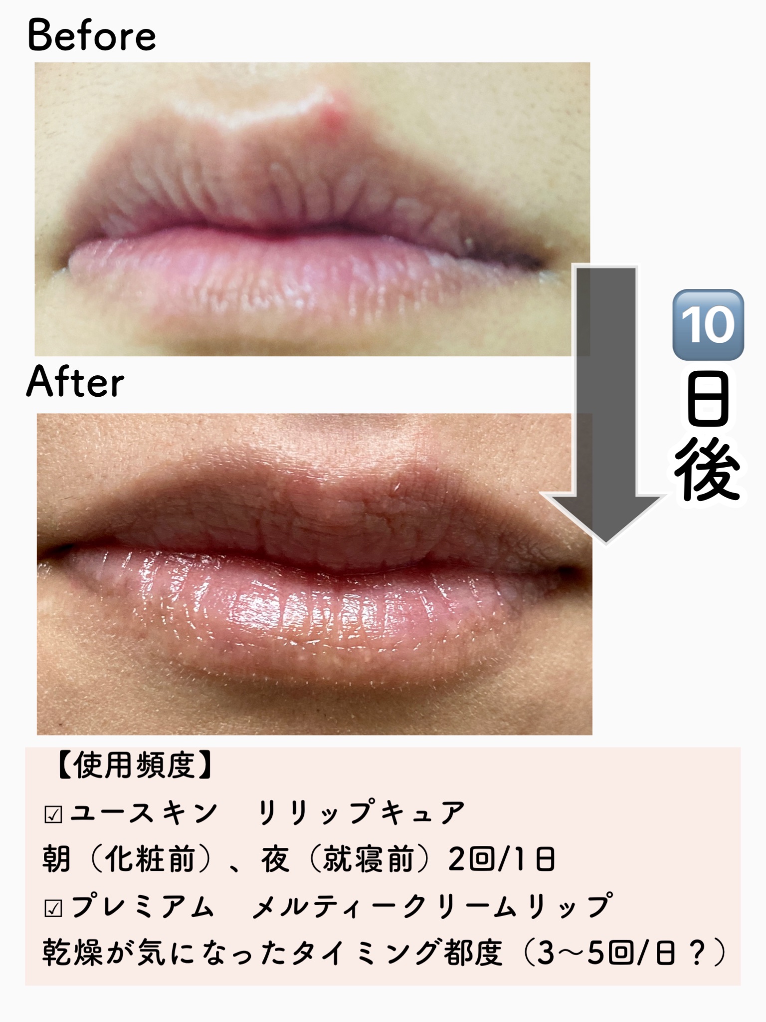 ユースキン メディカルリップクリーム 　(医薬品)/ユースキン/その他を使ったクチコミ（2枚目）