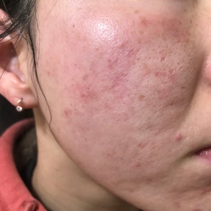 Glucolic Acid 30% Gel Peel/YEOUTH/ピーリングを使ったクチコミ(1枚目)