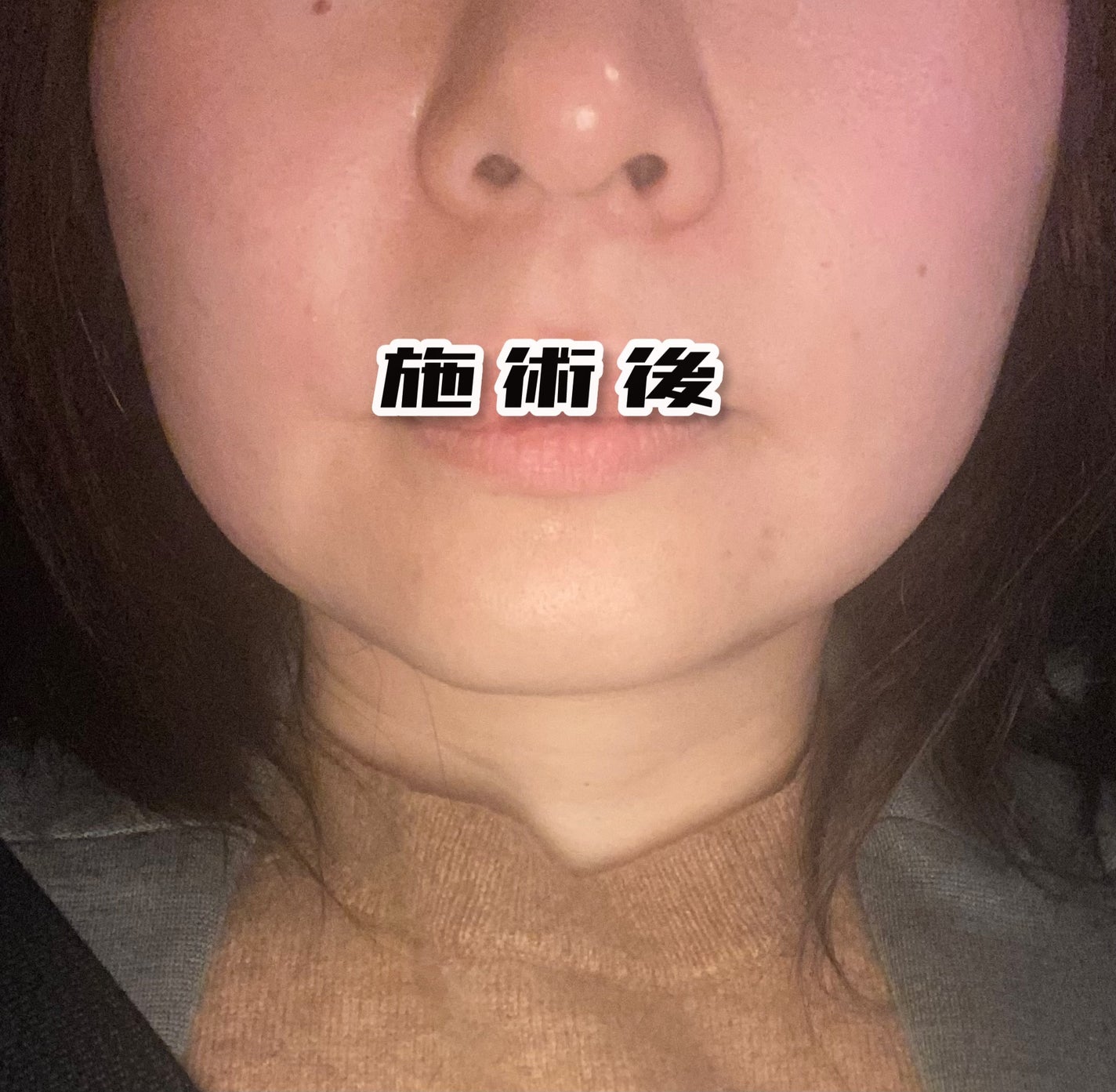 ゆみこさん on LIPS 「加工無しの画像です!!閲覧ご注意ください!!本日も白玉注射を打..」(3枚目)