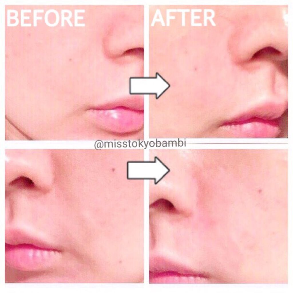 おやすみ中のしわ伸ばしテープ/MAGIE LAB/その他スキンケアグッズを使ったクチコミ(9枚目)