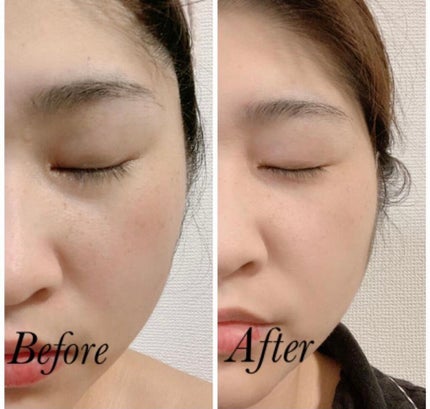 トラネキノールジェル/サンソリット/オールインワン化粧品を使ったクチコミ(5枚目)