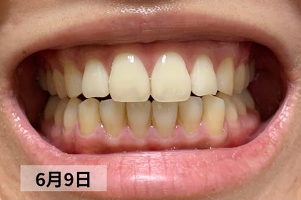 デンティス ホワイトニング チューブタイプ/デンティス/歯磨き粉を使ったクチコミ(8枚目)