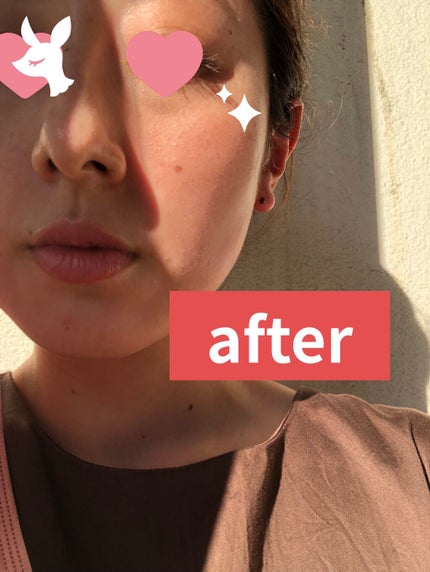 【旧】ディオールスキン フォーエヴァー スキン コレクト コンシーラー/Dior/リキッドコンシーラーを使ったクチコミ(4枚目)