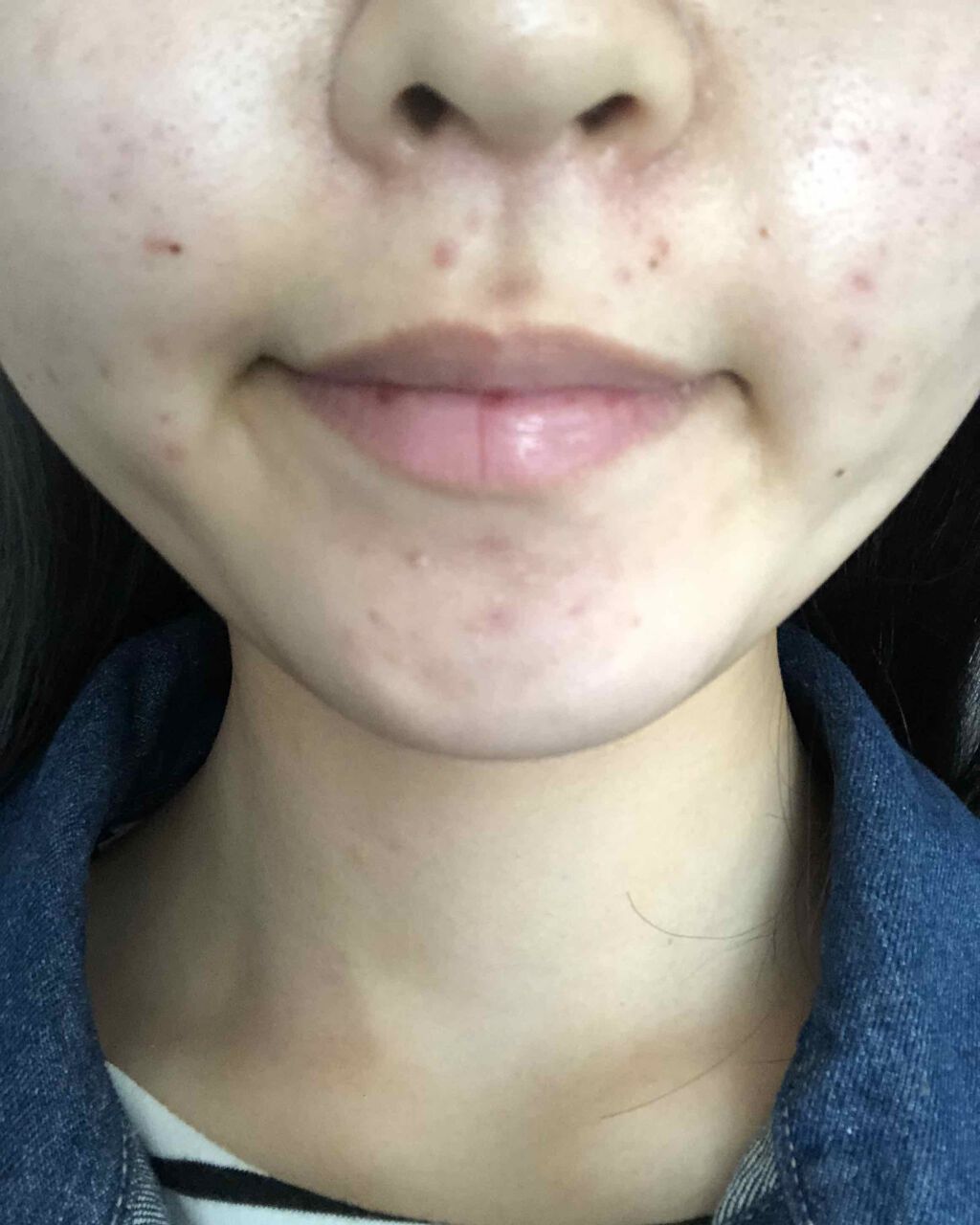 ペアアクネクリームW(医薬品)/ペア/その他を使ったクチコミ（2枚目）