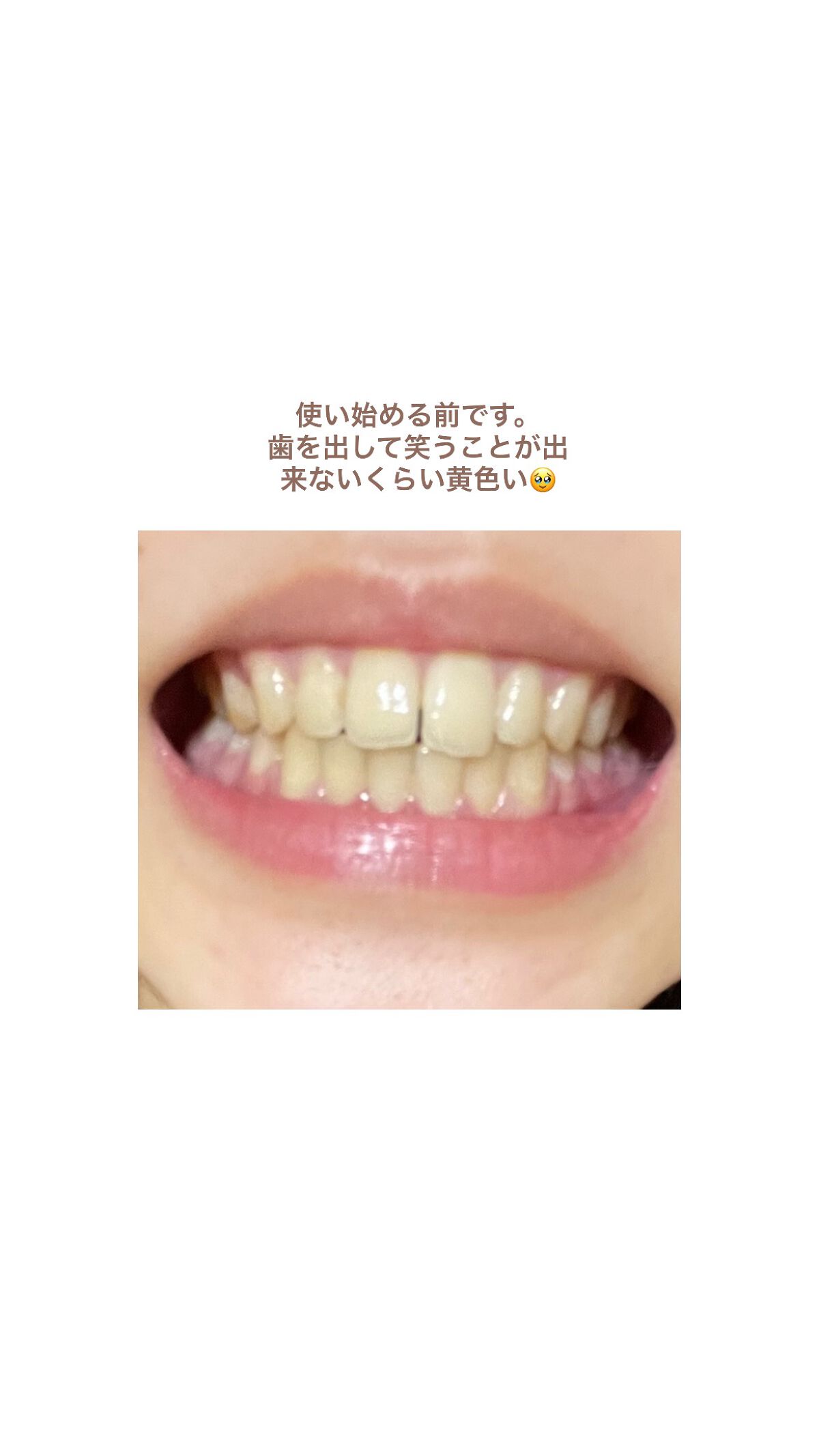 クレスト3Dホワイトニング ホワイトストリップ プロフェッショナル エフェクツ/クレスト/その他オーラルケアを使ったクチコミ(3枚目)