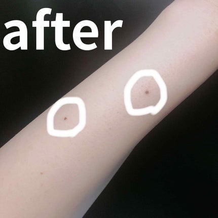 たむたむ on LIPS 「ほくろ除去ペンQoo10購入⚠️自己責任です⚠️以前ご紹介した..」(3枚目)