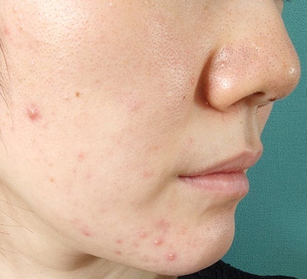 十味敗毒湯(医薬品)/ツムラ/その他を使ったクチコミ(3枚目)