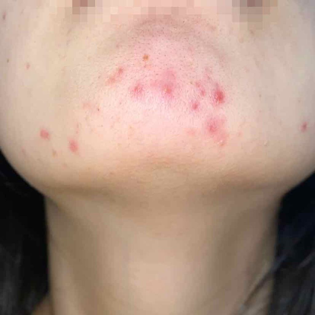 オキシドール(医薬品)/日本薬局方/その他を使ったクチコミ(4枚目)