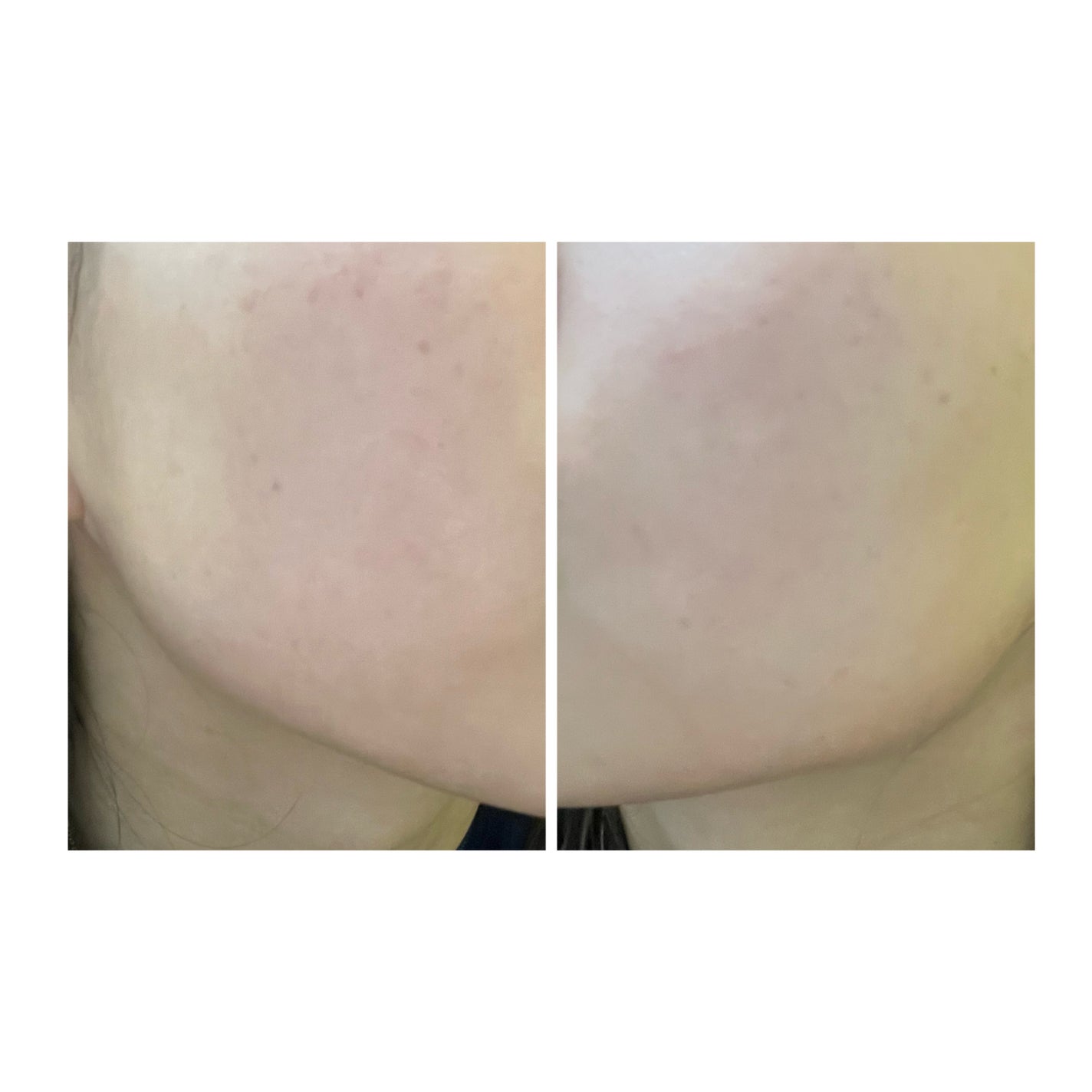 ぽむ on LIPS 「2023.9.13皮膚科に受診 エピデュオとヘパリン処方1枚目..」(2枚目)