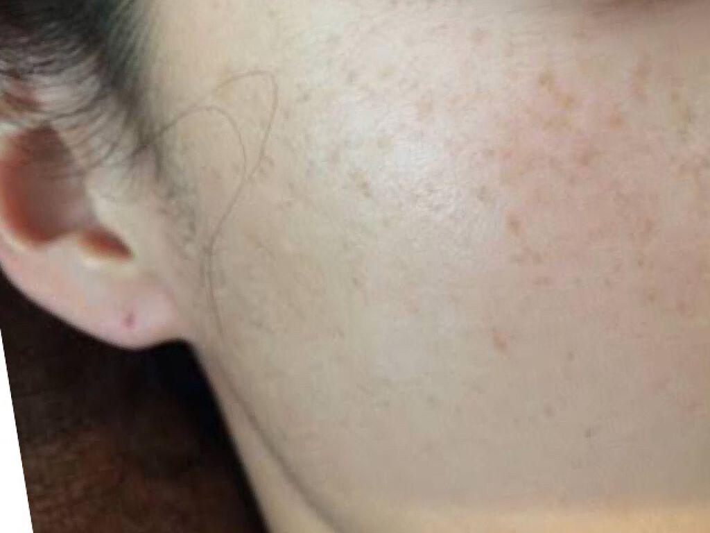 結フォロバ100% on LIPS 「飲んで1ヶ月半経過レポ明らか薄くなってるよ、しみ!産後から肝斑..」(1枚目)