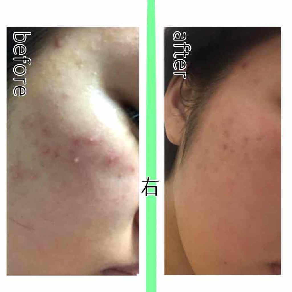 リヒト on LIPS 「投稿するかわからんかったけど写真撮っといてよかった。やっぱ皮膚..」(3枚目)