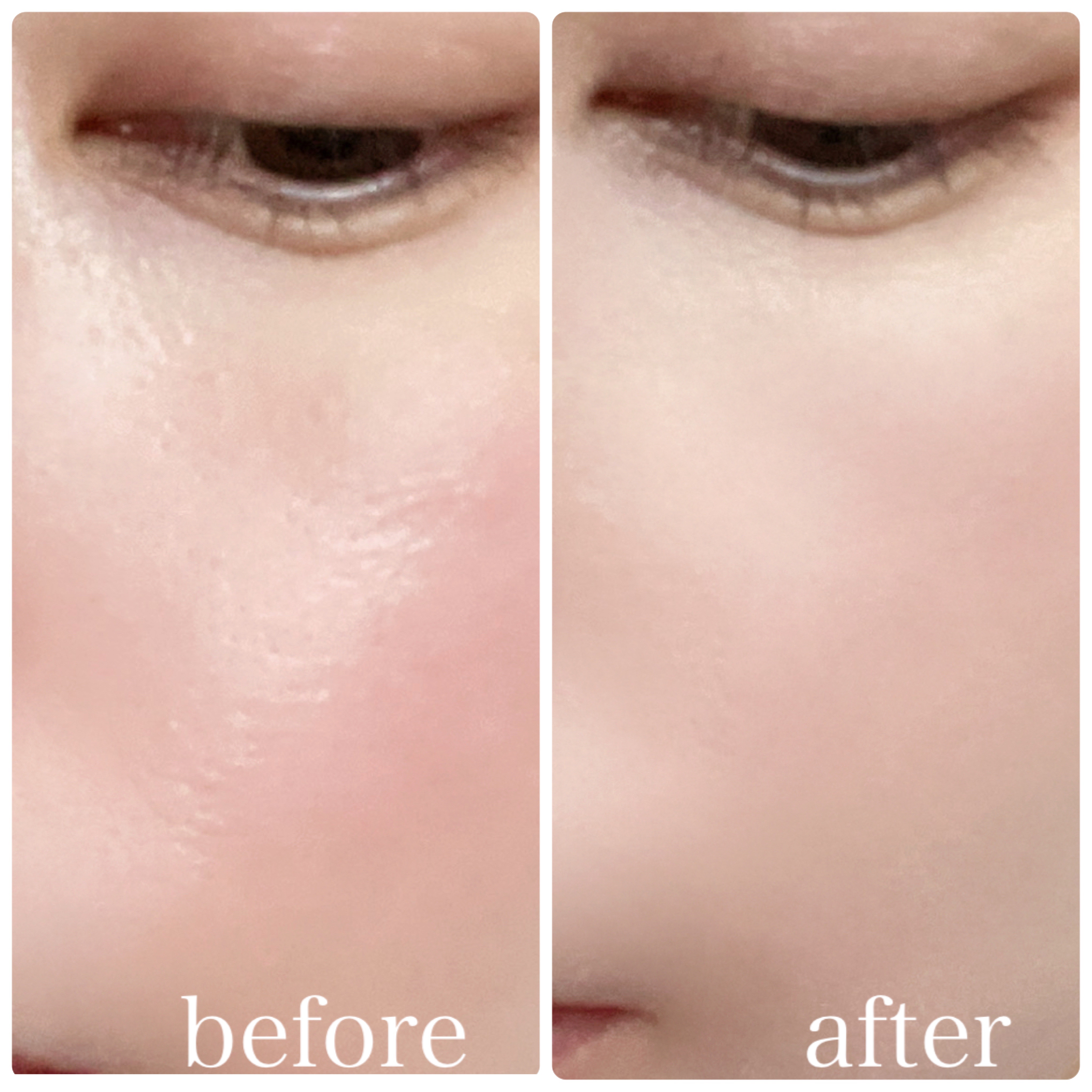 ピンクティーツリーカバーアップグロウクッション/APLIN/クッションファンデーションを使ったクチコミ（3枚目）